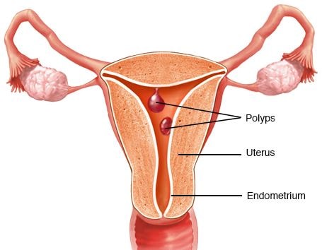 Polyps in Uterus