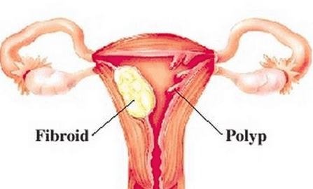 Polyps n fibroids in uterus