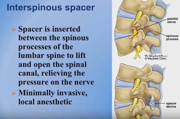 spacer-device