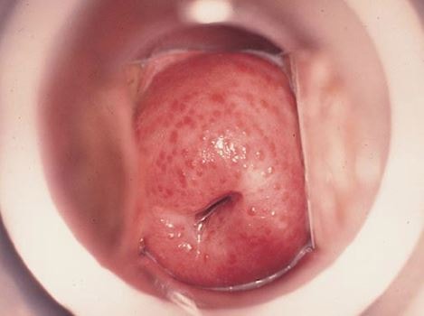 Strawberry Cervix Image