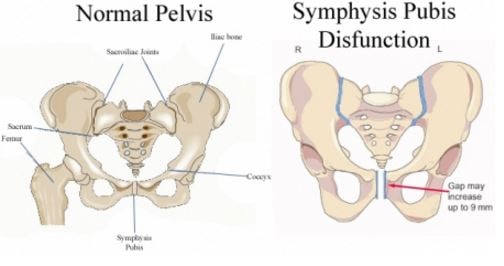 symphysis-pubis-dysfunction-image