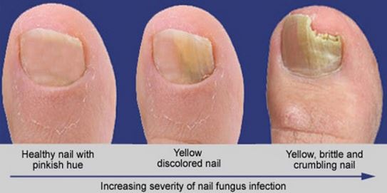 toenail fungus pictures