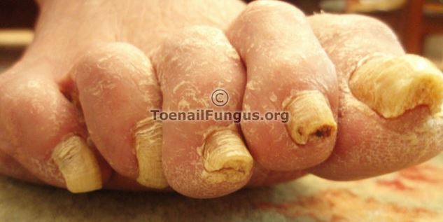 Toenail Fungus thick nails