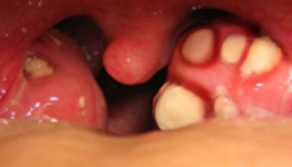 Tonsil Stones 3