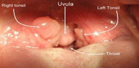 Tonsil Stones 4