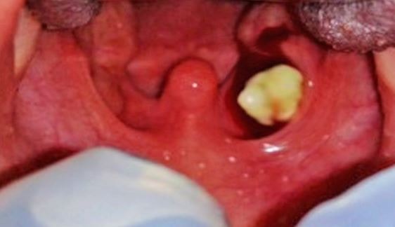 Tonsil Stones How to Get Rid, Removal, Causes, Prevent, Symptoms
