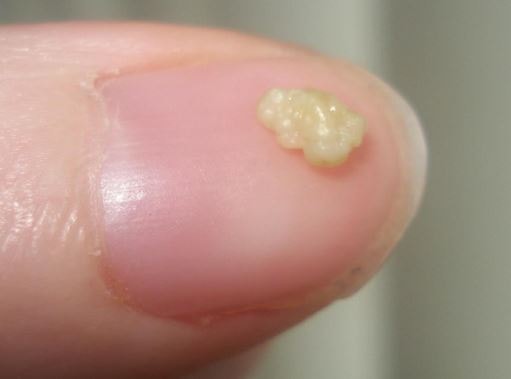 Tonsil Stones Removal picture 7
