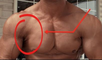 Torn Pectoral Muscle 1