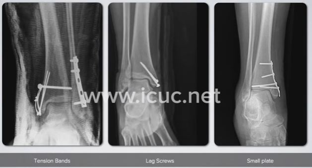 treatment-surgery-screws-plate-tension-bands