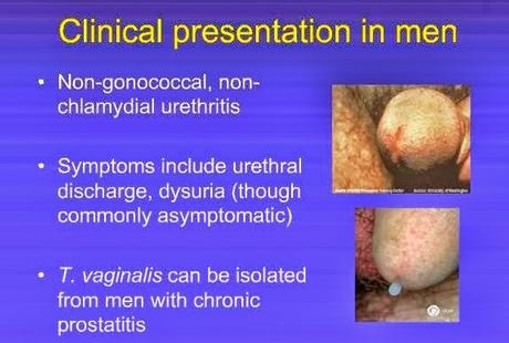 Trichomoniasis in men 2