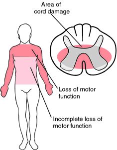 Central Cord Syndrome