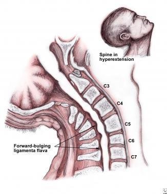 pathophysiology of central cord syndrome