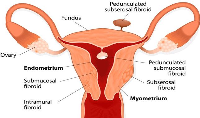 images of Polyps in uterus