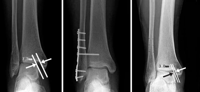 Lateral Malleolus Fracture surgery internal fixation