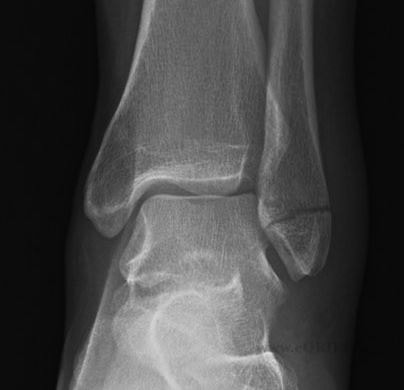 Lateral Malleolus Fracture photo