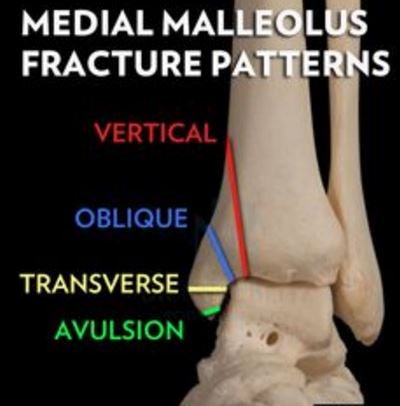 Medial Malleolus Fracture patterns