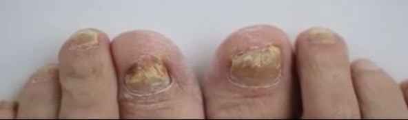 how to soften thick toenails for cutting