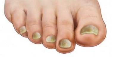 what causes thick toenails