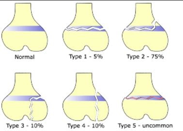 types-of-salter-harris-fracture