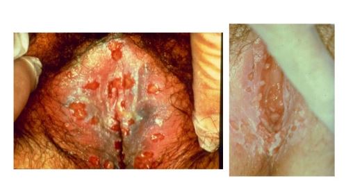 vaginal warts in feamles
