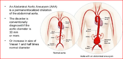 Abdomial Aortic Aneursym Symptoms