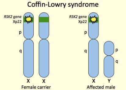 coffin lowry syndrome chromosomes
