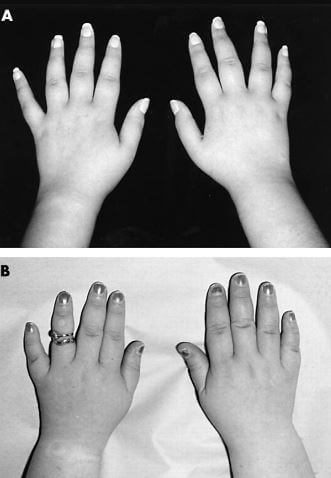 coffin lowry syndrome hands
