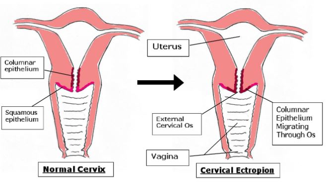Cervical Ectropion