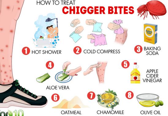 Chigger BItes Home Remedies
