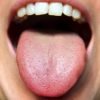 Circumvallate Papillae - Definition, Enlarged, Causes, Treatment, Symptom