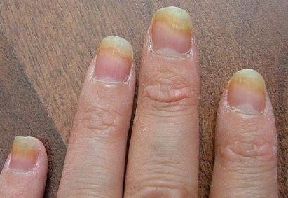 Fingernail Fungus