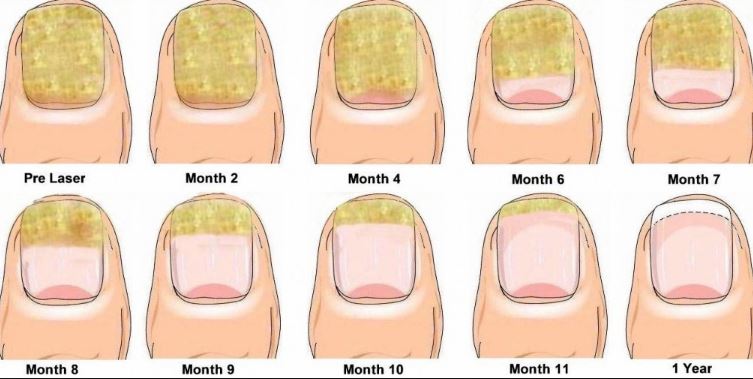 Fingernail Fungus Treatment How To Get Rid Pictures Home Remedies