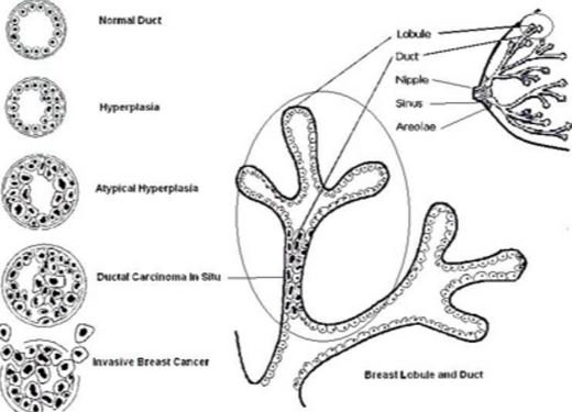 Atypical Ductal Hyperplasia