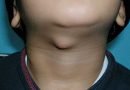 Thyroglossal Duct Cyst - Pictures, Symptoms, Treatment, Removal