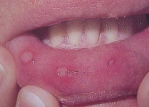 Herpangina - Pictures, What is?, Causes, Treatment, Symptoms, Contagious