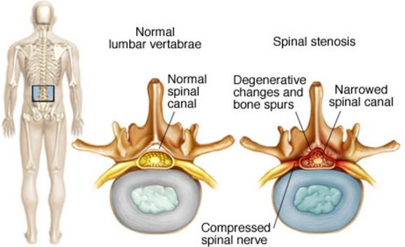 narrowing of the space in between vertebrae