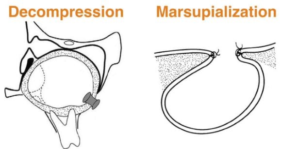 Marsupialization - Definition, What is?, Indications, Complications, Images
