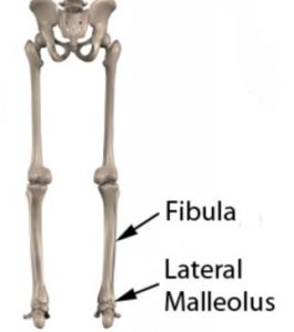 lateral malleolus fracture bruising