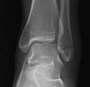 lateral malleolus fracture picture