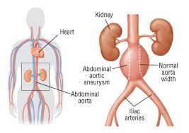 An abdominal aortic aneurysm